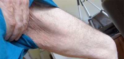 Skinny Fat, Cellulite, Loose Skin