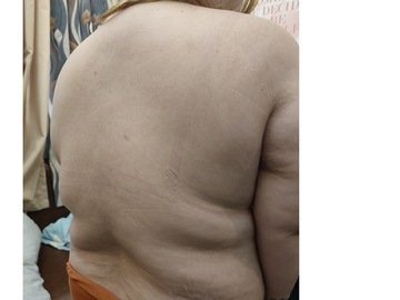 The Four Body Types Body Type Four (BT4) Research Participant 482