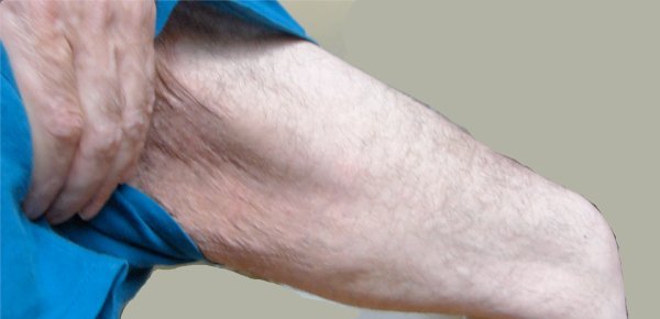 What Is Skinny Fat (Normal Weight Obesity)?